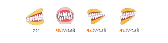 정상, 제1급부정교합, 제2급부정교합, 제3급부정교합